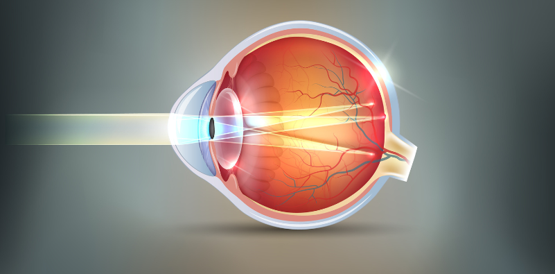 A vector image showing the change in shape of the eye, which causes astigmatism.