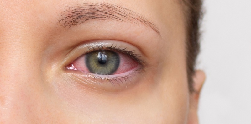 A close up of a woman’s face with a red eye.