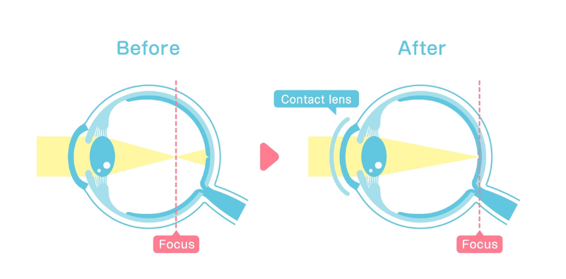 An illustration comparing vision with and without wearing contact lenses.